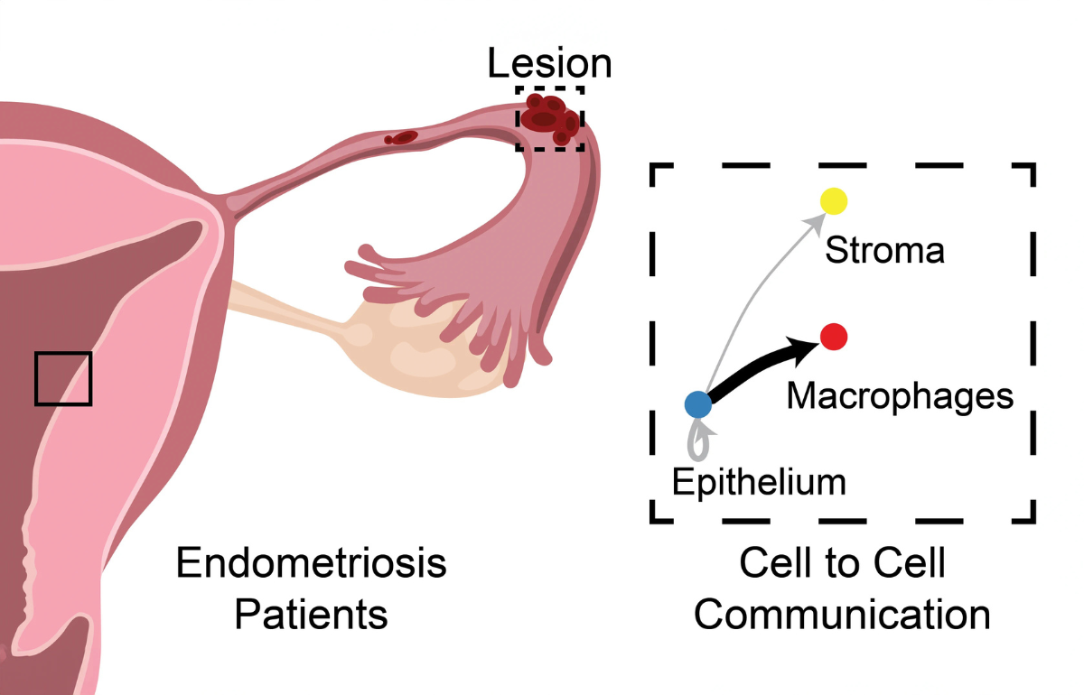 glutathione endometriosis Can Endometriosis-Related Oxidative Stress Pave the Way for New Treatment Targets? The effect of dinitrosyl iron