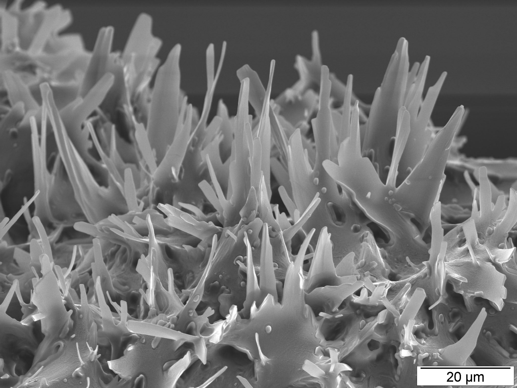 Cholesterol crystals in carotid artery.