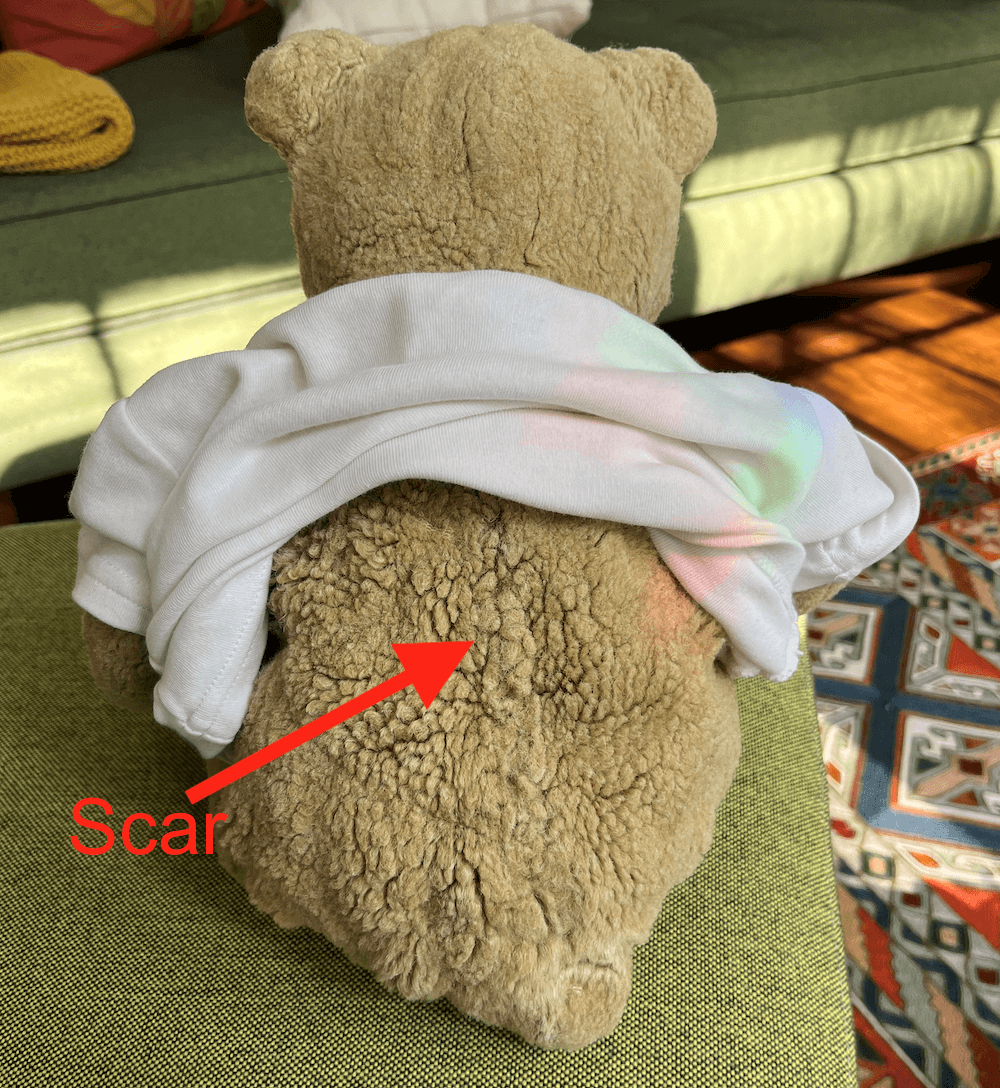 a stuffed teddy bear showing off its "scar" from being patched and sewn.
